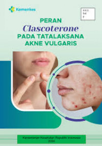 Peran Clascoterone pada Tatalaksana Akne Vulgaris